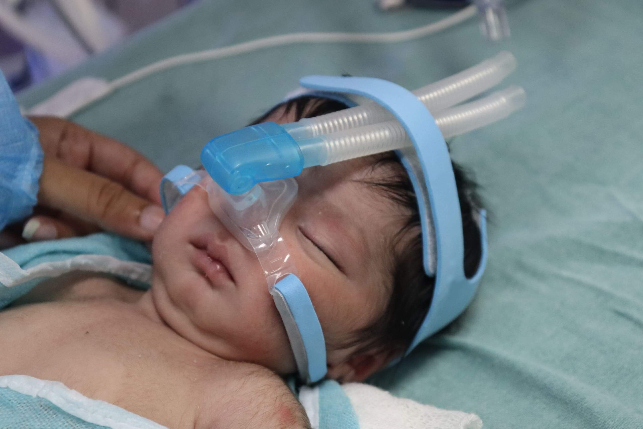“NEST”  – Redesign of CPAP Interface for neonates in NICUsWork Photo